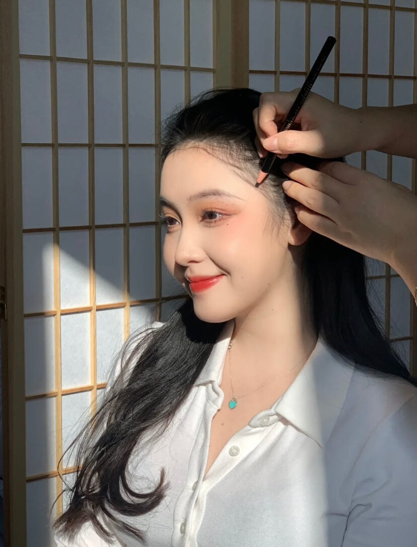 Receding Hairline Treatment