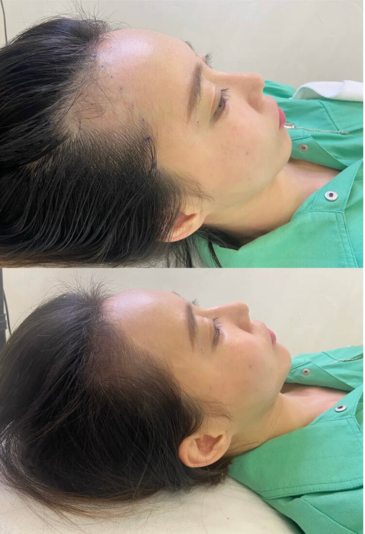 Receding Hairline Treatment