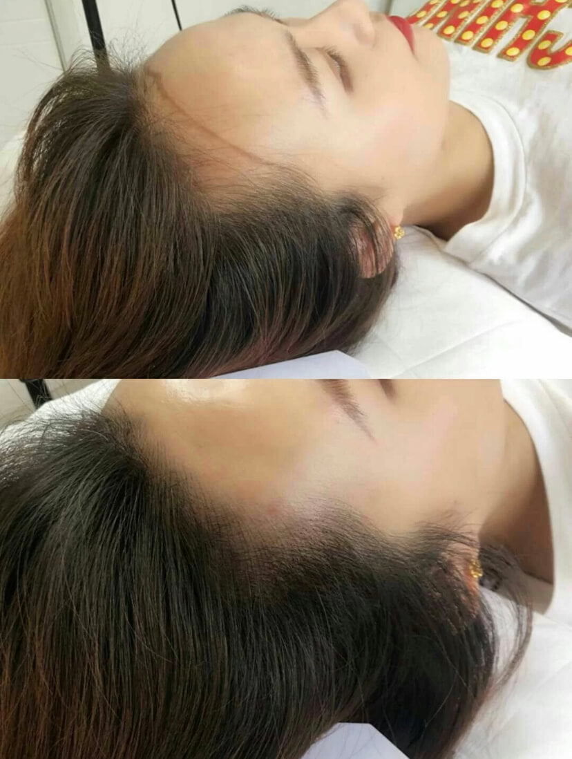 Receding Hairline Treatment